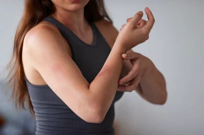Widoczne zmiany skórne i zaczerwienienia na ramieniu kobiety – przykład objawów alergii skórnej lub AZS